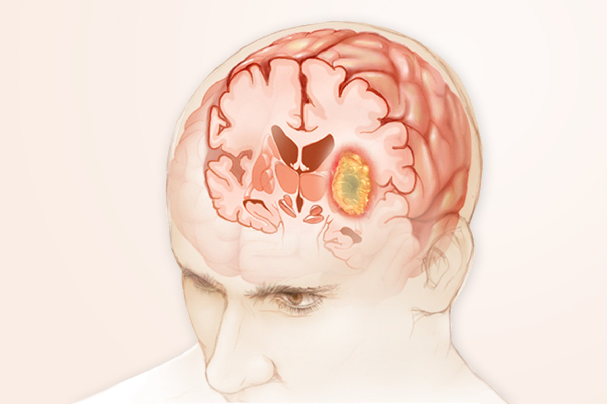 Brain Tumors