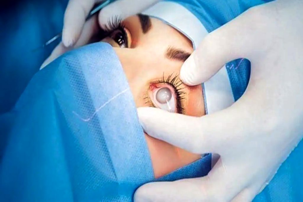 Cataract Surgery