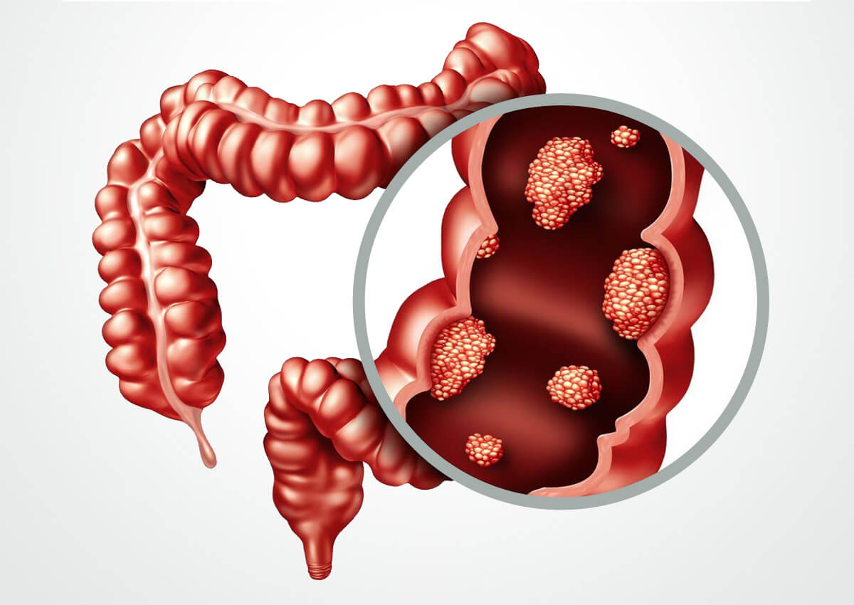 intestine cancer