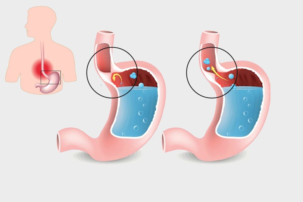 Food Pipe Irritation