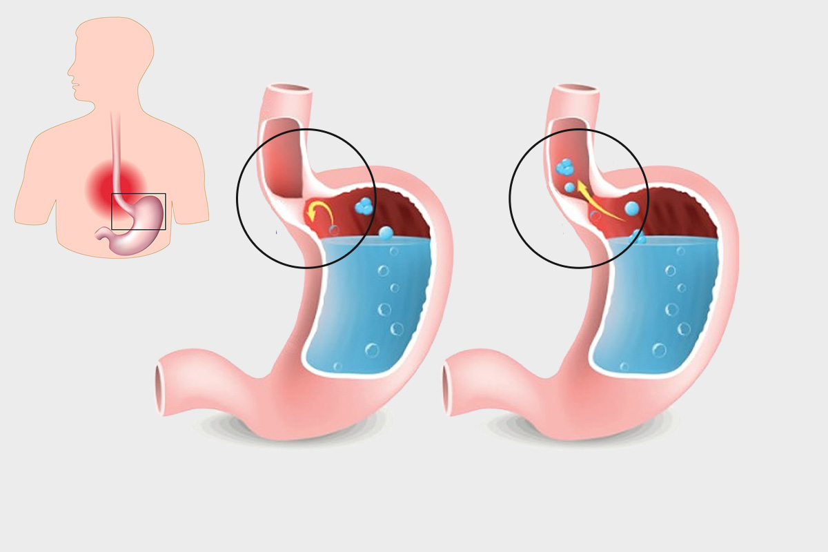 Food Pipe Irritation