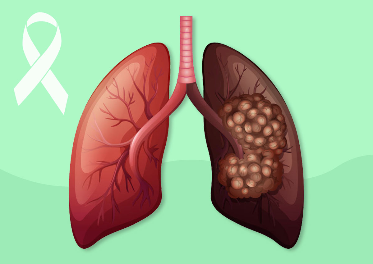 Lung Cancer Awareness